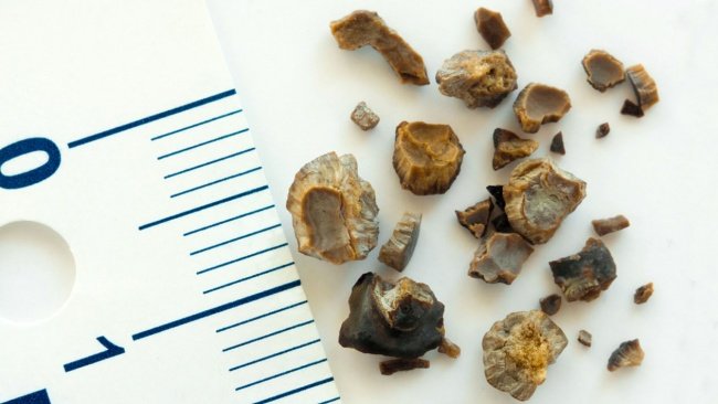 Gejala dan Faktor Risiko Batu Ginjal yang Harus Diwaspadai